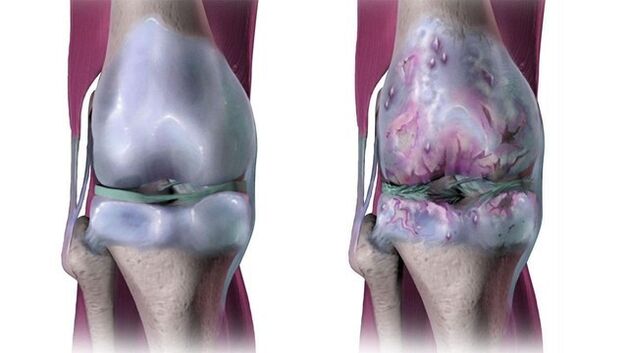 Gezond kniegewricht en aangetast door artrose