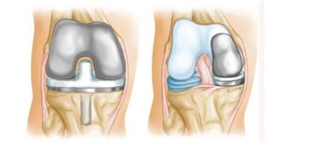 artroplastiek voor artrose van het kniegewricht
