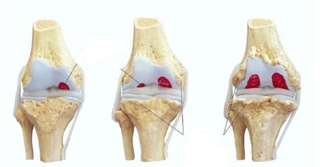 stadia van artrose van het kniegewricht