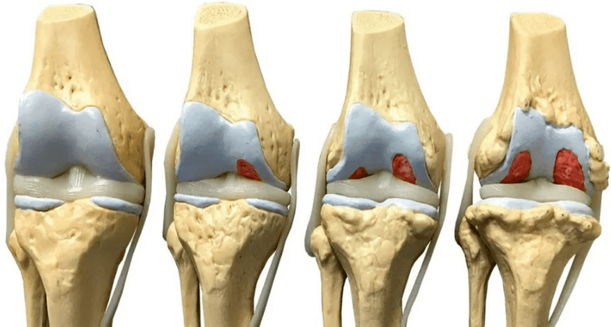schade aan het kniegewricht in verschillende stadia van de ontwikkeling van artrose