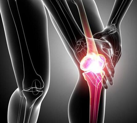 schade aan het kniegewricht met artritis en artrose