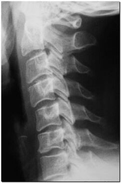 Röntgenfoto van de cervicale wervelkolom