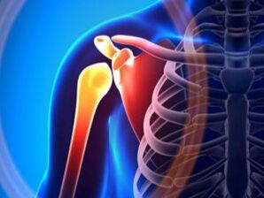Ontstoken schoudergewricht als gevolg van artrose - een chronische ziekte van het bewegingsapparaat