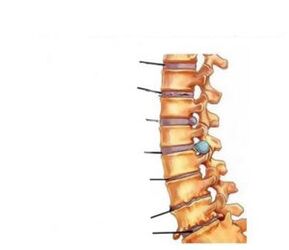 Symptomen van osteochondrose