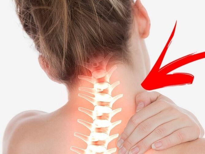 Compressie van zenuwwortels met cervicale osteochondrose