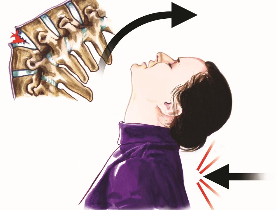 beschadiging van de wervelkolom als oorzaak van nekpijn