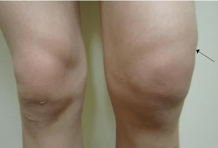 Hemarthrosis van het kniegewricht